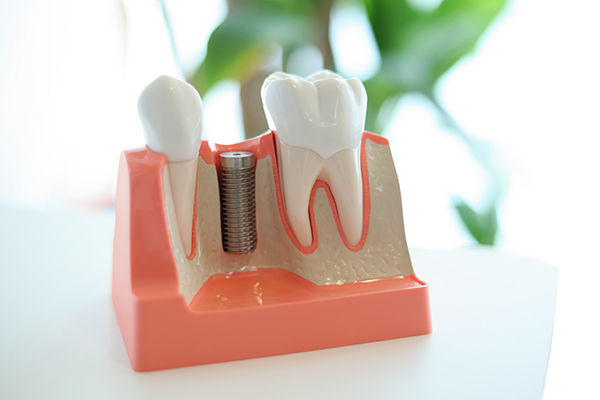 かんばら歯科クリニック 大阪市平野区 歯周病治療を専門にしている