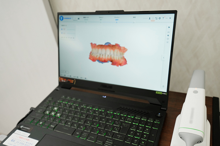別部歯科医院  横浜市港南区 歯並びのデータを採りシミュレーションを行う口腔内スキャナー