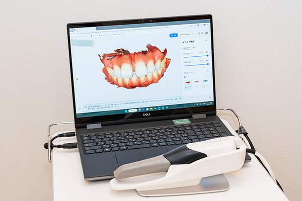 さわ歯科クリニック　 染め出しをし、3D口腔内スキャナーで撮影