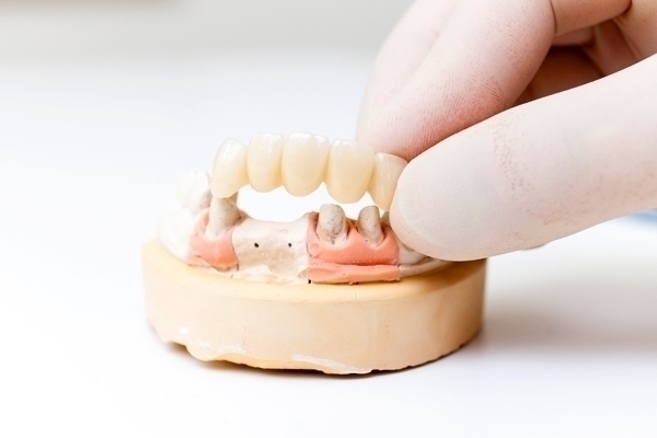 銀座はけた歯科医院 完成した修復物を装着