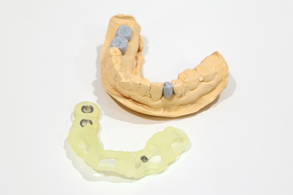 にしむら歯科医院 人工歯を装着して治療が完了