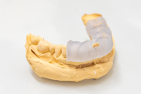 松田歯科クリニック 人工歯の装着