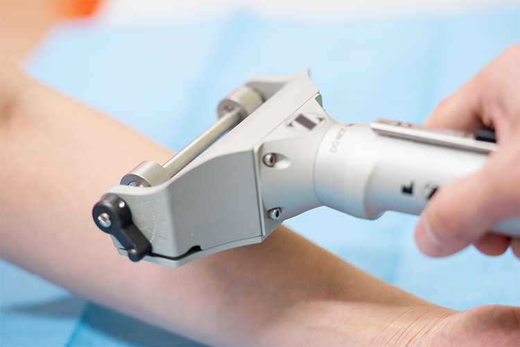 きずときずあとのクリニック豊洲院 リストカットの傷痕 別の傷痕に見せるための戻し植皮手術