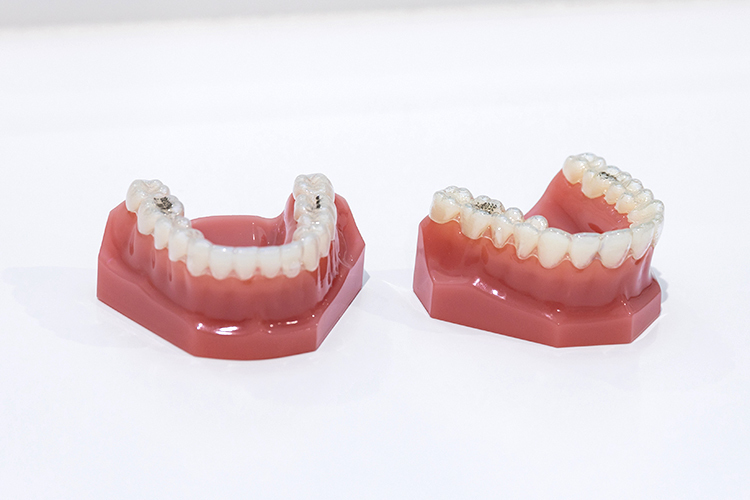 医療法人くわばら歯科医院 3Dシミュレーションで確認可能 マウスピース型装置を用いた矯正