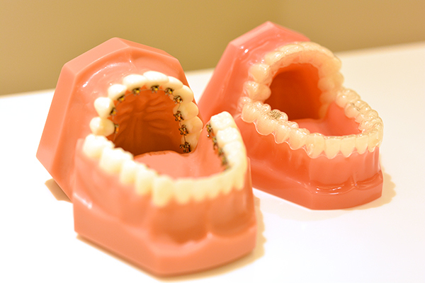 矯正歯科医院大阪オルソ 装置が目立たない裏側矯正