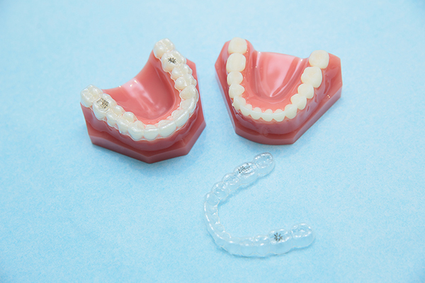 尼崎N’s歯科口腔クリニック 幅広い世代からのニーズが高い、マウスピース型装置を用いた矯正
