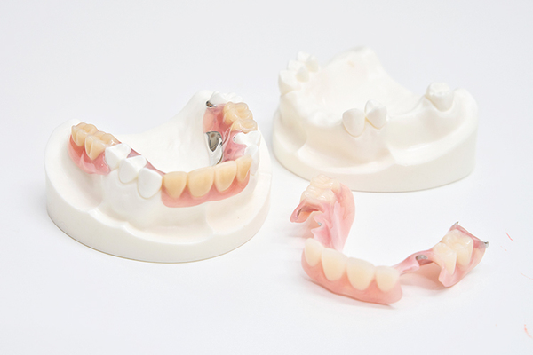 ブランカ歯科医院 口腔内の実態をしっかりと把握して義歯を作製することが重要