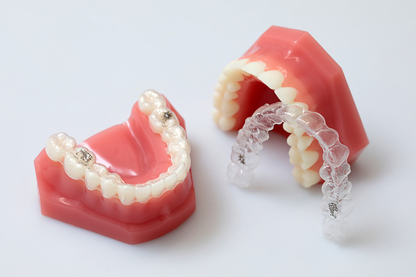 池袋駅東口つのり歯科 取り外し可能なマウスピース型装置は口腔内をきれいに保ちやすい