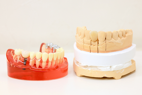 木下歯科医院 より自然な仕上がりをめざすことが可能な「セラミック治療」