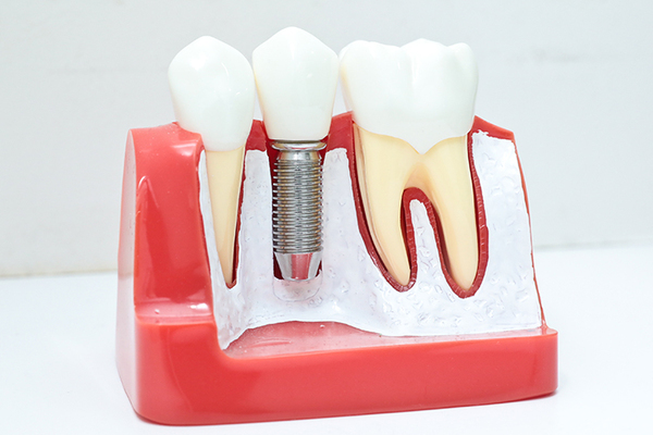 松葉通り歯科クリニック 模型を用いるなどして、患者にわかりやすく説明している