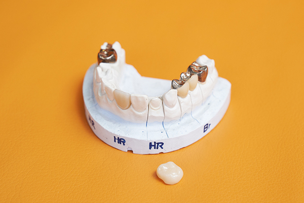 上田歯科医院 より審美的で長持ちするものを希望の場合は自由診療が勧められる