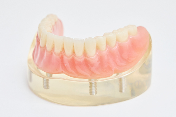 ブランカ歯科医院 義歯設計ソフトなどの先進のデジタル機器も活用