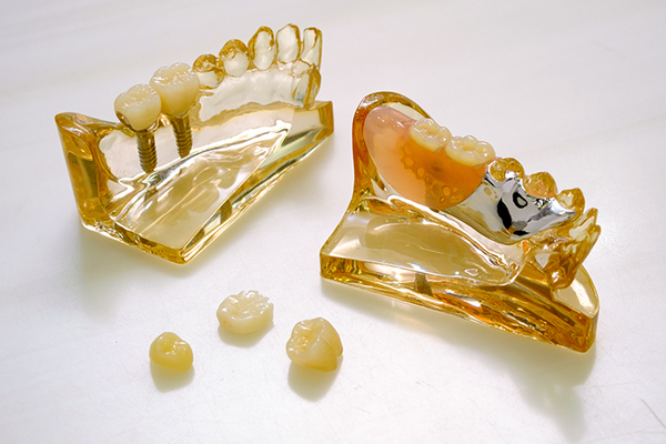 鈴木歯科医院 より快適で選択肢が幅広い自由診療の入れ歯