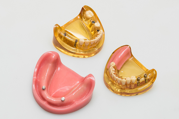 きよはら歯科クリニック 多様なインプラント治療がある