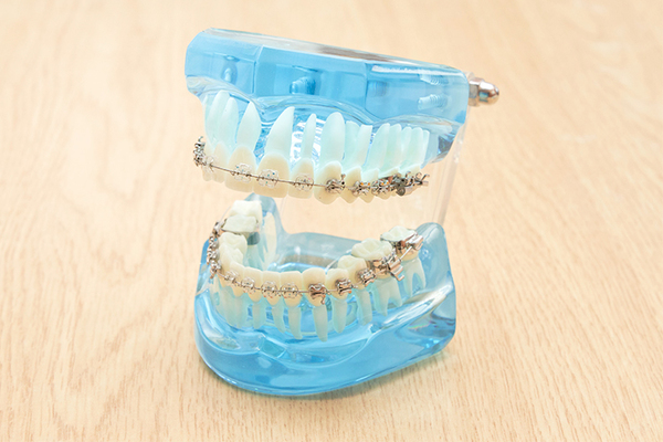 しゅういち矯正歯科クリニック 患者一人ひとりに応じて、さまざまな対応が可能なワイヤー矯正