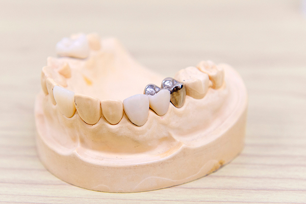 あいあーる歯科目黒駅医院 患者一人ひとりに合った素材を選び修復する