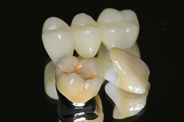 ナルトミ歯科医院 口腔内の状況に合わせて補綴装置の素材を選ぶことができる