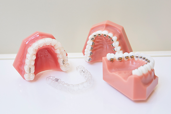 矯正歯科医院大阪オルソ 裏側矯正とマウスピース型装置を組み合わせるハイブリッド矯正