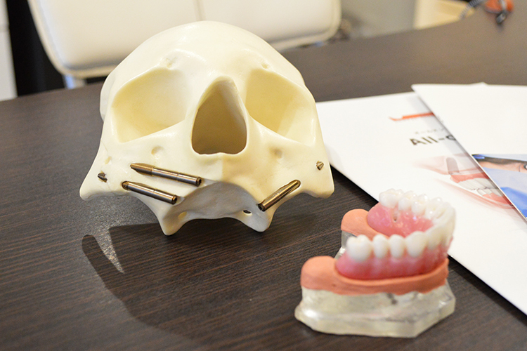 GDHインプラントオフィス札幌 骨が薄くても治療が可能な 頬の骨にインプラント体を埋入する術式