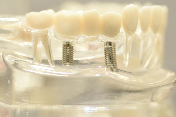 平安通歯科クリニック 生涯にわたり良好な口腔状態を 予防を見据えたインプラント治療