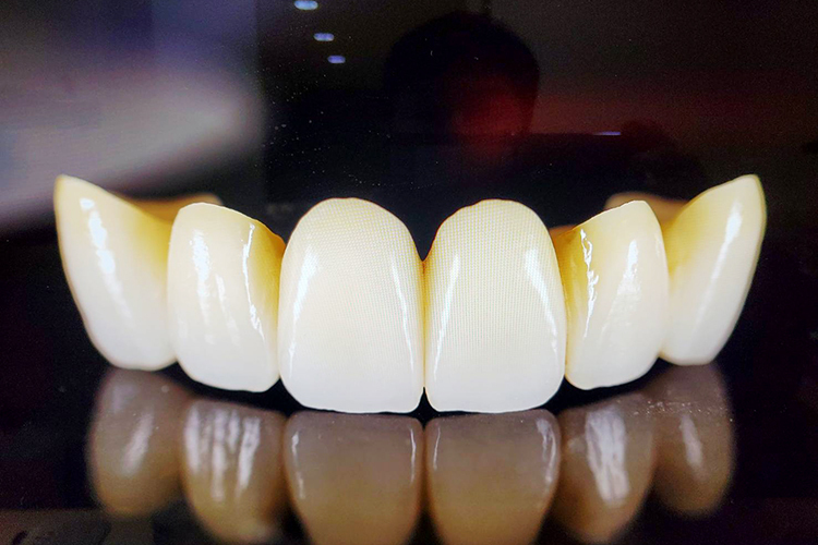 耐久性や生体親和性に着目 メリットの多いセラミック治療 ドクターズ ファイル